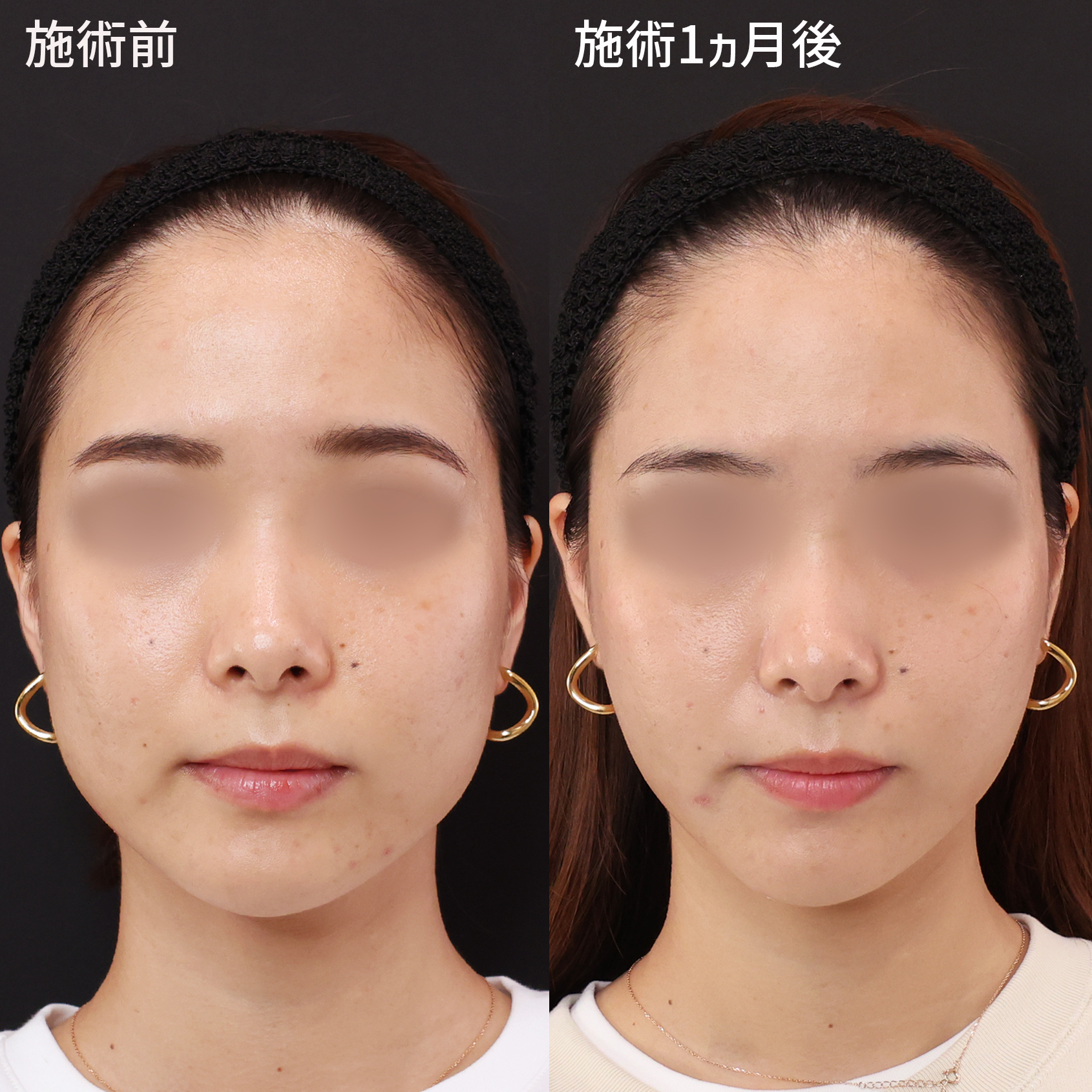 口元整形 唇整形 唇ヒアルロン酸 口角挙上 人中短縮 安い値段で横浜taクリニック 神奈川 横浜の美容整形 美容外科